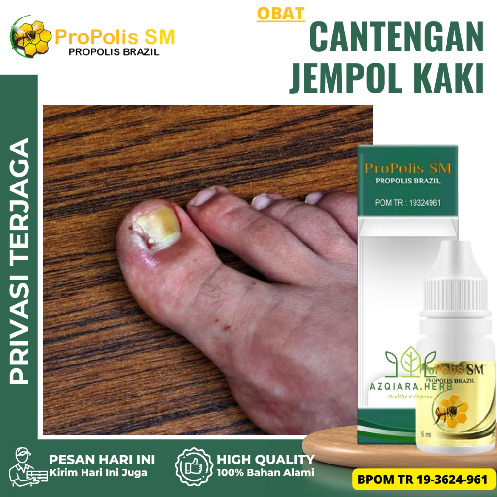 Obat Cantengan Jempol Kaki, Obat Jamur Kuku Kaki, Obat Cantengan Bengkak Bernanah, Obat Jempol Kaki 