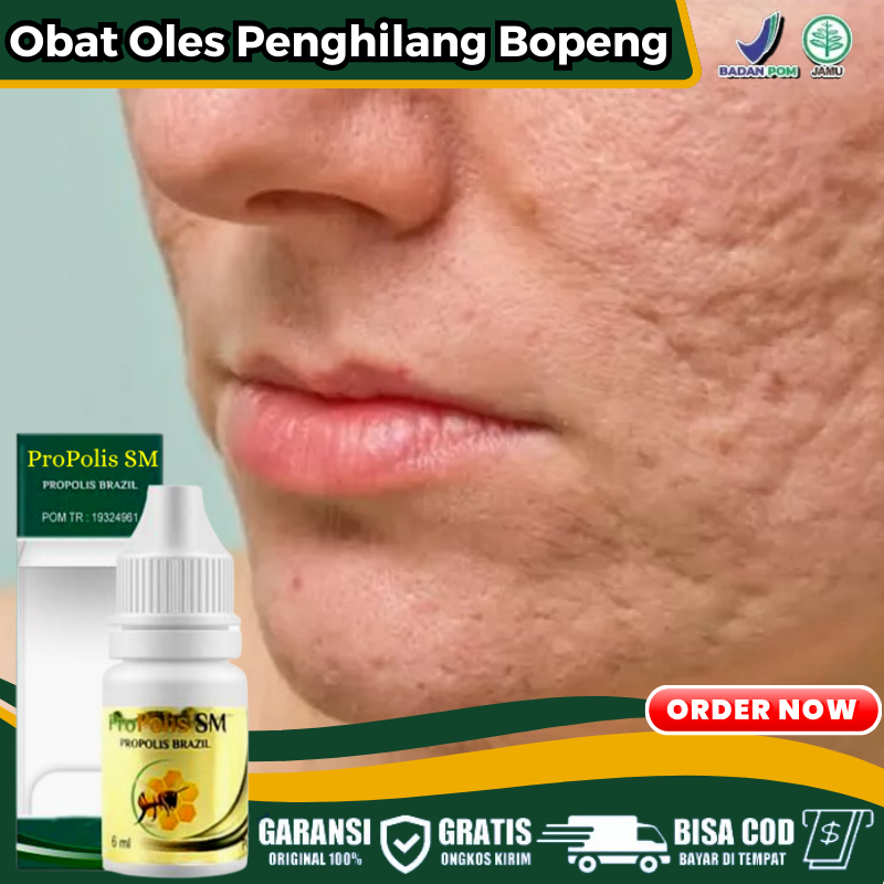 Obat Oles Atasi Bopeng Berlubang Bekas Jerawat, Meratakan Wajah Bopeng Berlubang Lubang, Obat Bopeng