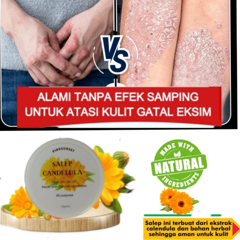 Salep Natural Calendula Healing Salve Salep Eksim Kering Salep Gatal Psoriasis Salep Kulit Kering da