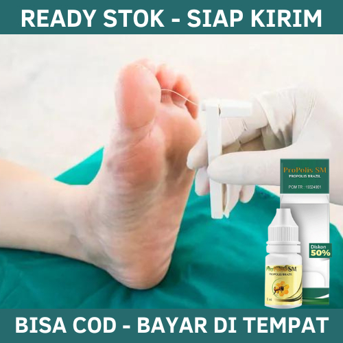 Obat Luka Diabetes Agar Cepat Kering, Obat Luka Diabet Alami, Obat Luka Diabetes, Obat Luka Diabetes