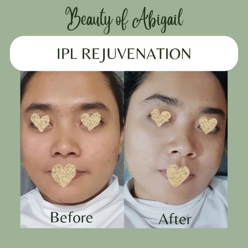 IPL Skin Rejuvenation Treatment