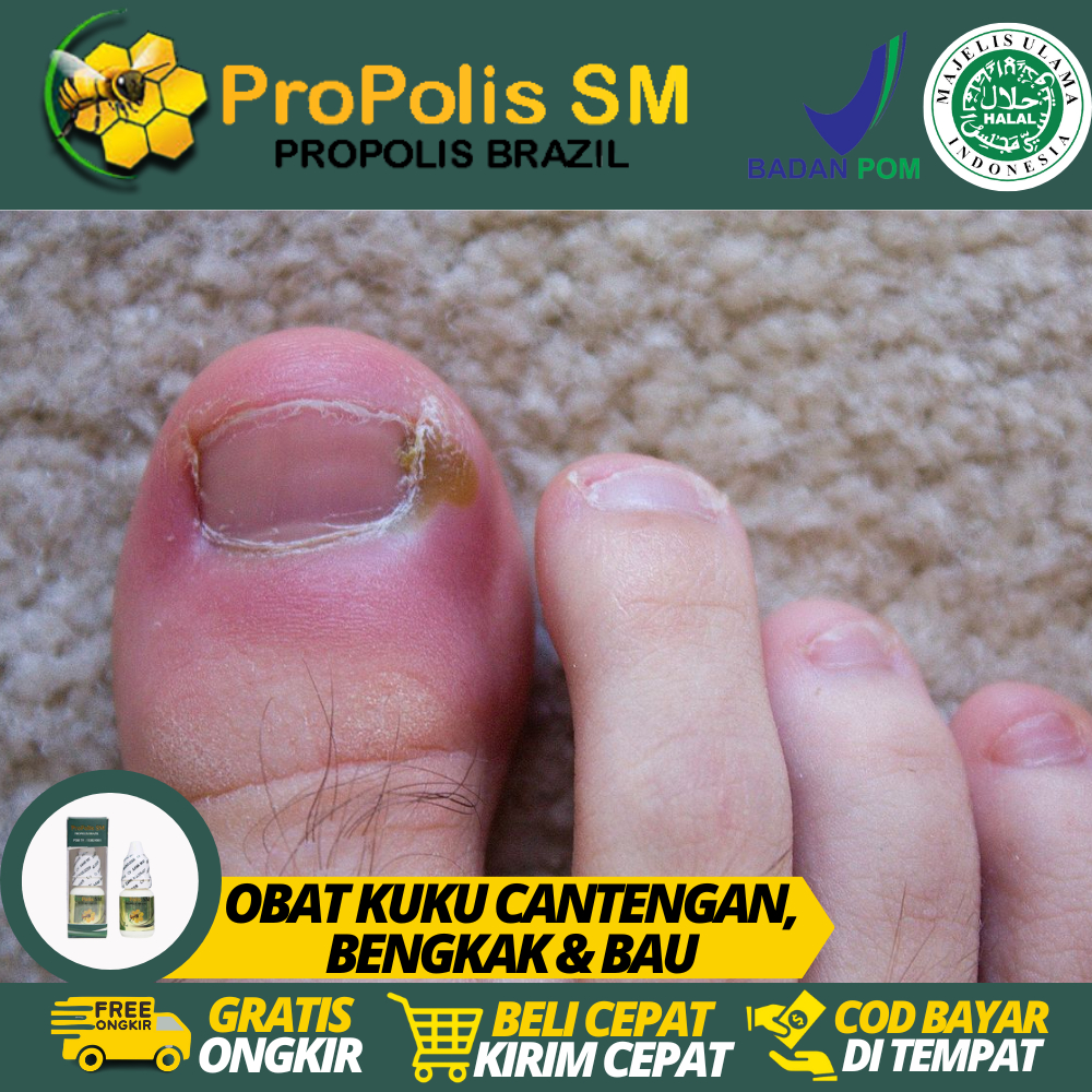 Obat Cantengan, Cantengan Jempol Kaki, Cantengan Kuku Tangan, Obat Cantengan Jempol Kaki Bernanah, C