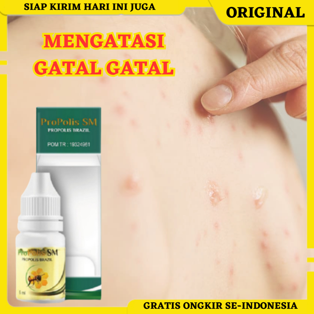 Propolis SM, Obat Gatal, Obat Gatal di Tangan, Obat Gatal di Kaki, Obat Penghilang Gatal, Obat Gatal