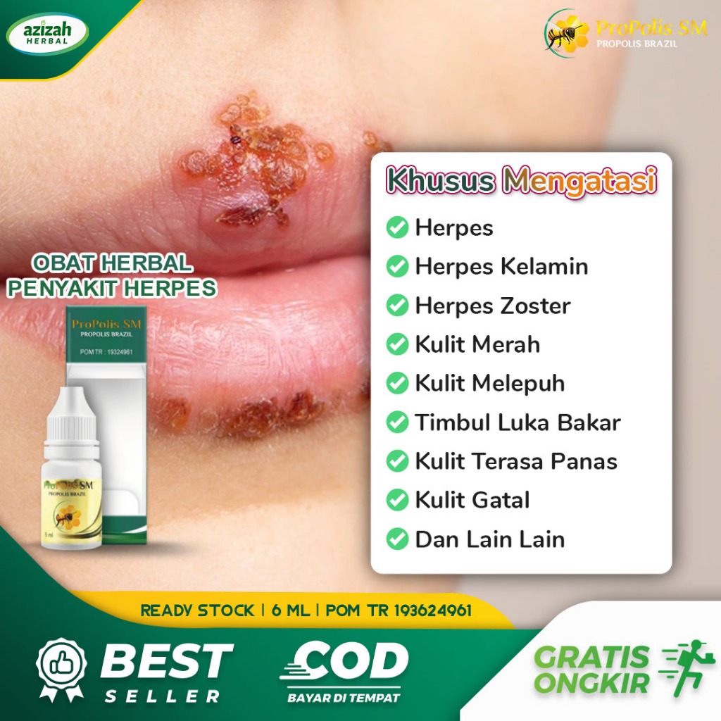 Obat Herpes Bayi Anak Dewasa Salep Herpes Zoster Genital Simpleks Kulit
Merah Melepuh Terasa Panas Oleskan Propolis SM Brazil Asli