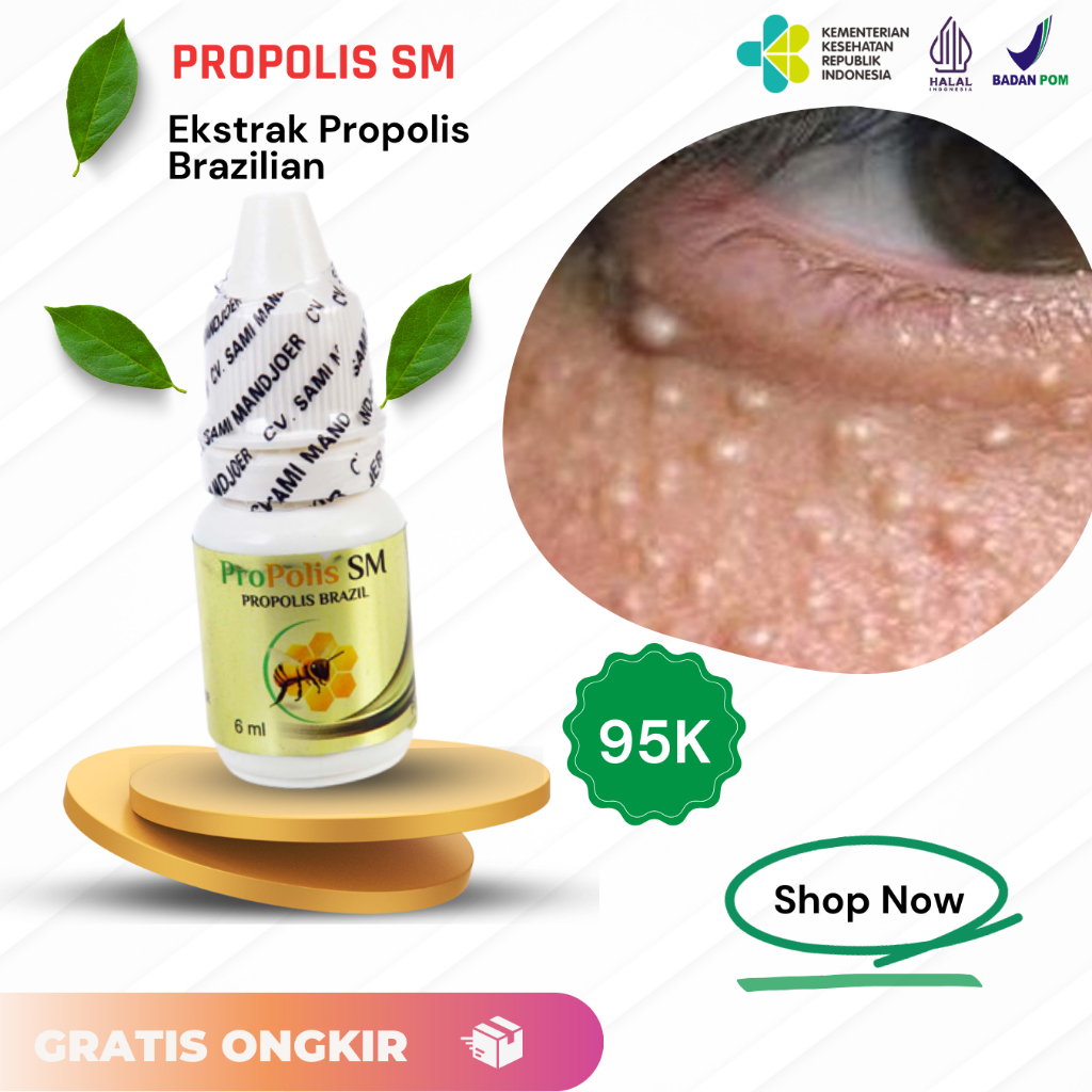 Obat Milia Dibawah Mata Serum Milia / Kutil Mata Bintik Bintik Putih Milia Pada Wajah Penghilang Bin