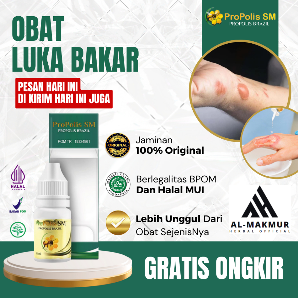 Obat Luka Bakar, Obat Bekas Luka Bakar, Obat Penghilang Bekas Luka Bakar, Obat Luka Terkena Minyak P