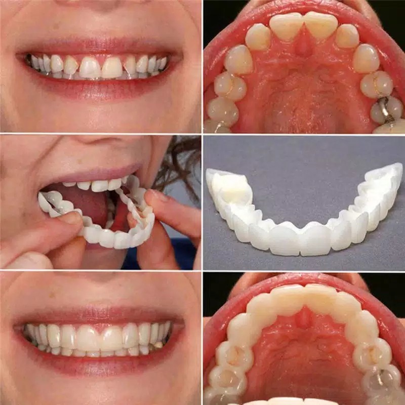 SUPERMARKET IMPORT Snap On Smile Original 100% Snap On Smile Sepasang 1 Set Atas Bawah Veneers Gigi