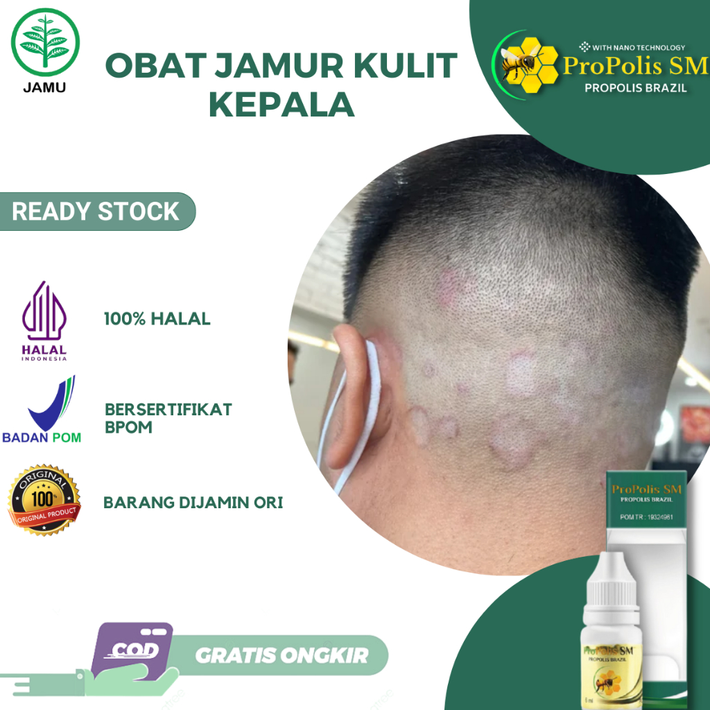 Obat Jamur Kulit di Kepala, Obat Tetes Kulit Kepala Berjamur, Kulit Kepala Berkerak, Obat Gatal Kuli