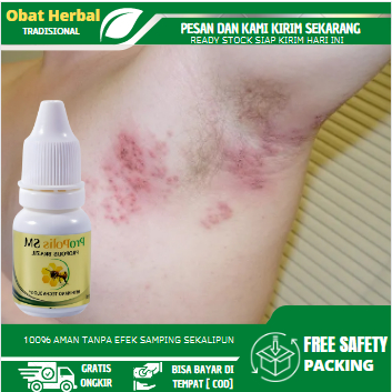 Obat Ketiak Gatal, Ketiak Gatal Bintik Merah, Lipatan Ketiak Lecet, Iritasi Ketiak, Infeksi Jamur Ke