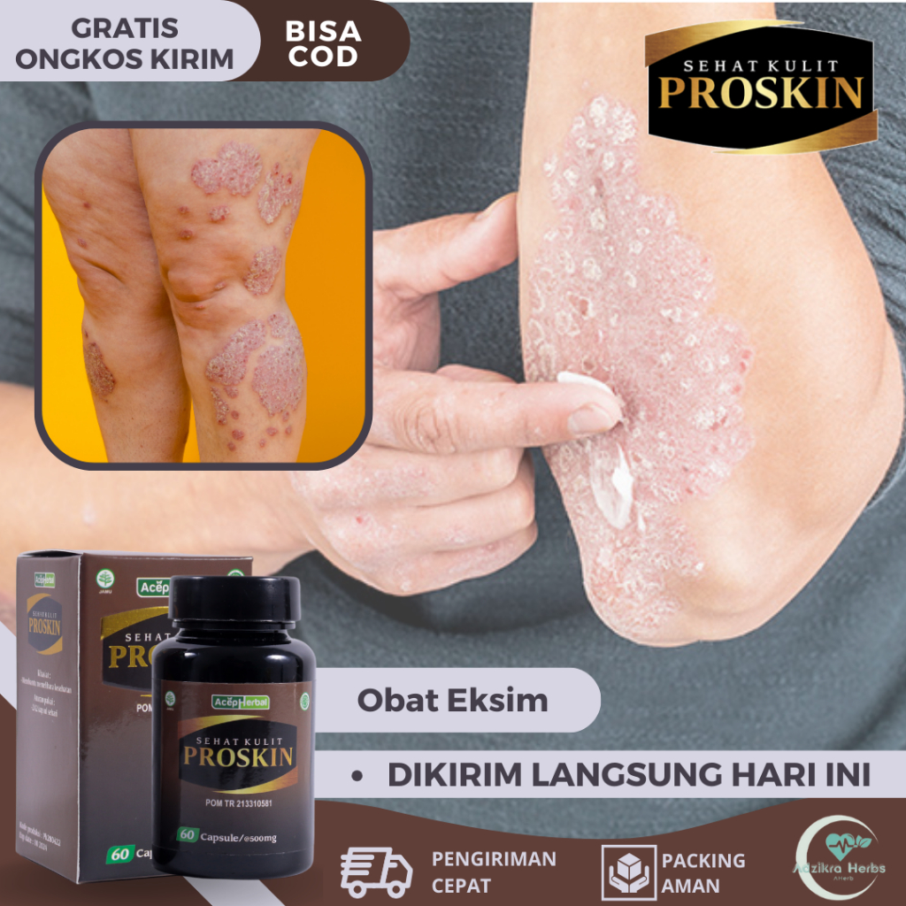 Obat Kulit Eksim, Obat Eksim Kering, Obat Eksim Menahun, Obat Dermatitis Seboroik, Obat Jamur Kulit 