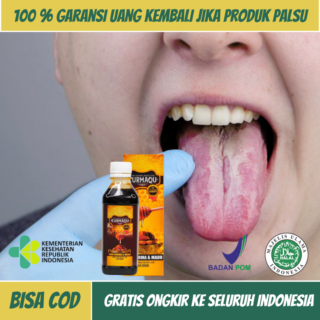 Obat Radang Lidah Putih, Obat Lidah Putih Berjamur, Obat Lidah Putih Terasa Pahit, Obat Bercak Putih