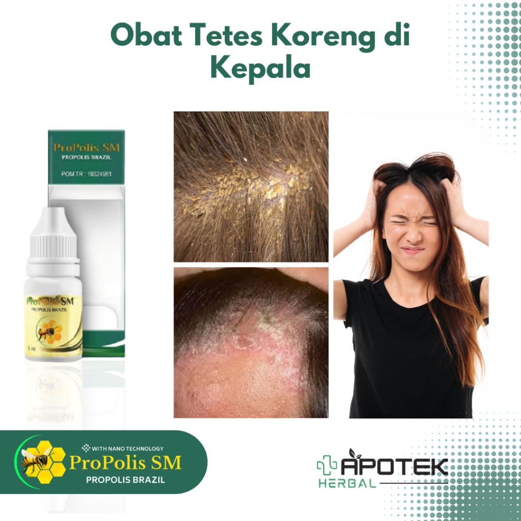Obat Koreng di Kepala Borok Kurap Psoriasis Kulit Kepala Kering Bersisik Jamur Kulit Kepala Tinea Ca