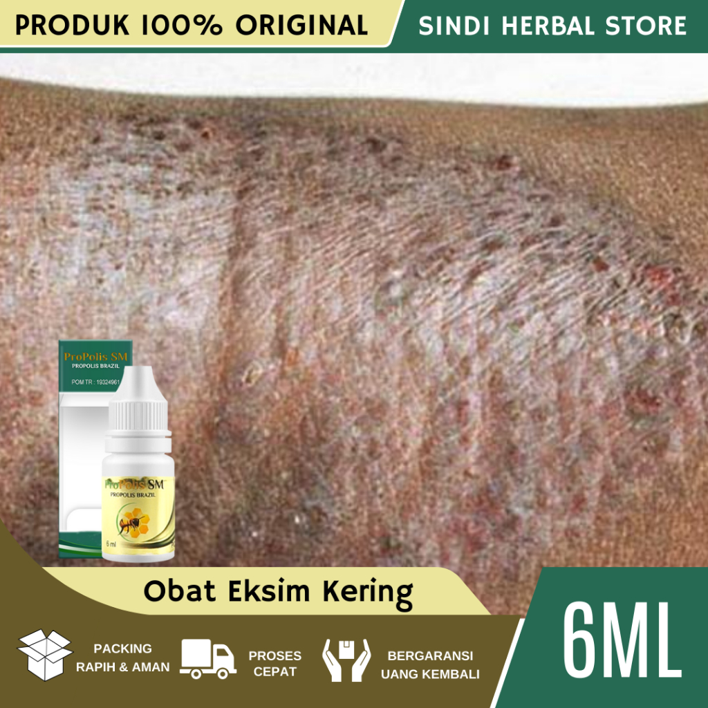 Obat Eksim Kering Manahun, Obat Eksim, Obat Eksim Menahun, Obat Eksim Kering, Obat Eksim Basah, Sale