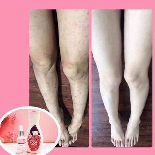 COCOSOM SERUM + LOTION PENGHILANG BEKAS LUKA KORENG BUDUKAN + PEMUTIH KULIT TUBUH BADAN ANAK ANAK BA