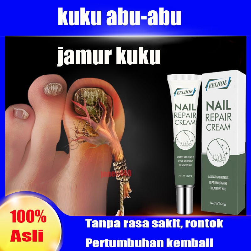 Anti Jamur Kuku Onikomikosis Paronychia Herbal Cina Obat kuku Obat jamur kuku Obat kuku jamur dan ru