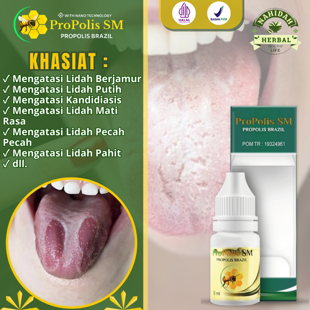 Obat Lidah Berjamur, Lidah Putih, Obat Kandidiasis, Obat Lidah Pecah Pecah, Lidah Kering, Lidah Mati