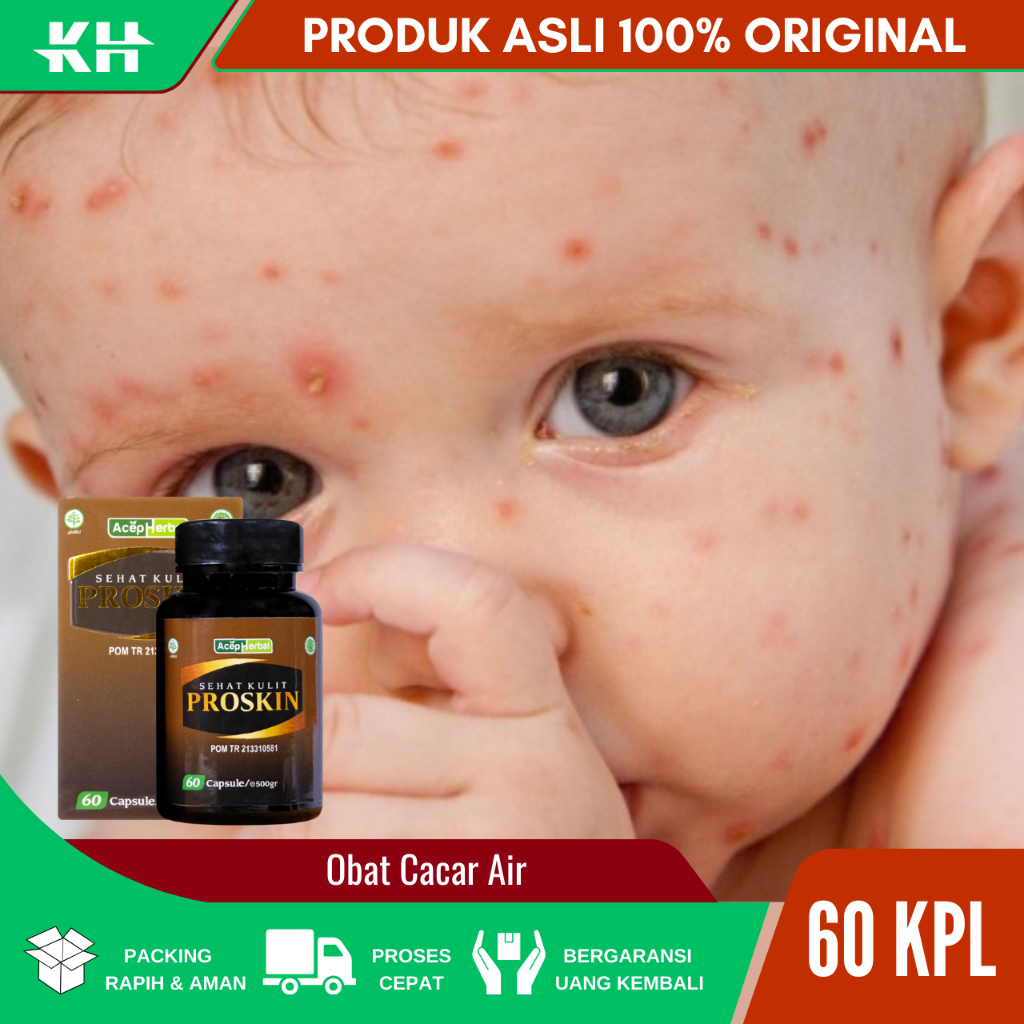 Obat Cacar Air Anak, Obat Cacar Air Dewasa, Obat Cacari Air bayi, Obat Cacar Air, Obat Cacar Api, Ob