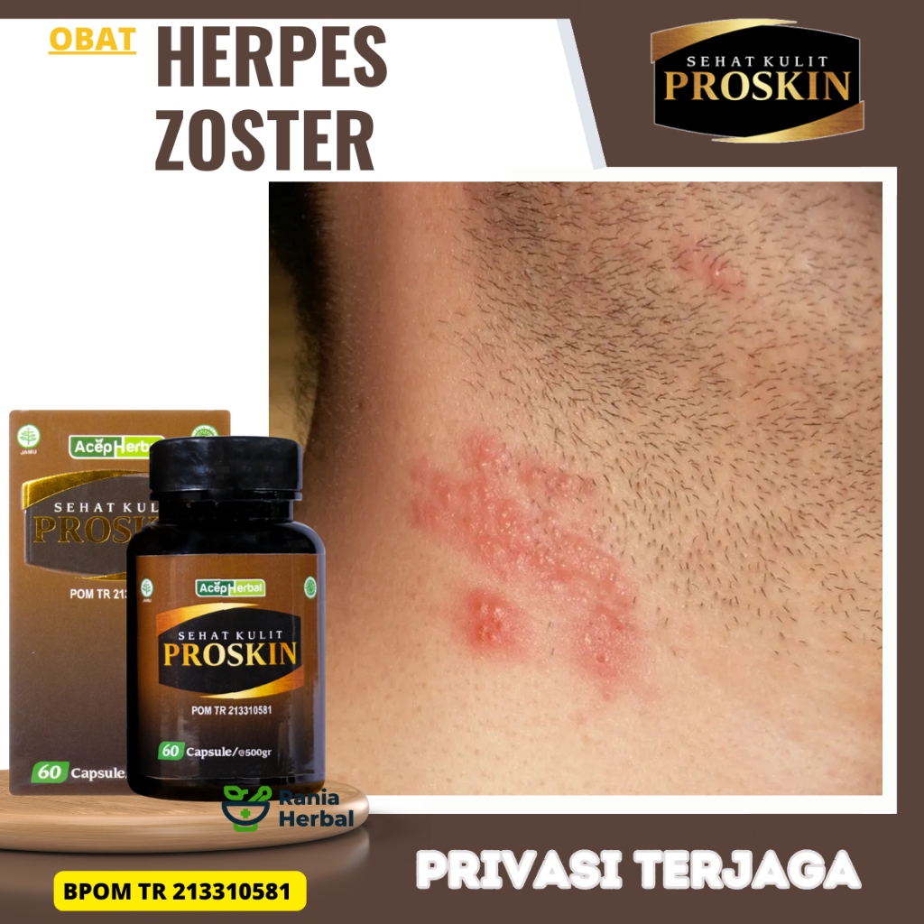Obat Herpes Zoster, Obat Cacar Air, Obat Herpes Bibir, Obat Herpes Kelamin, Obat Penghilang Herpes, 