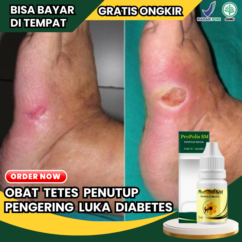 Salep Cair Pengering Luka Diabetes Bernanah Pengobatan Luka Diabetes Basah Kering Diabetes Melitus O
