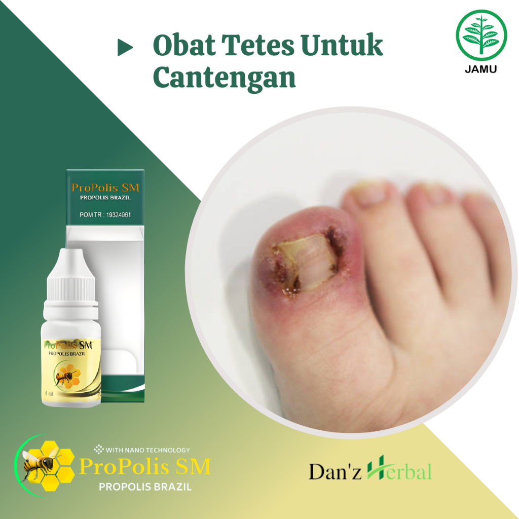 Obat Tetes Cantengan, Obat Kaki Cantengan, Obat Cantengan Jempol Kaki, Obat Cantengan Bernanah, Obat