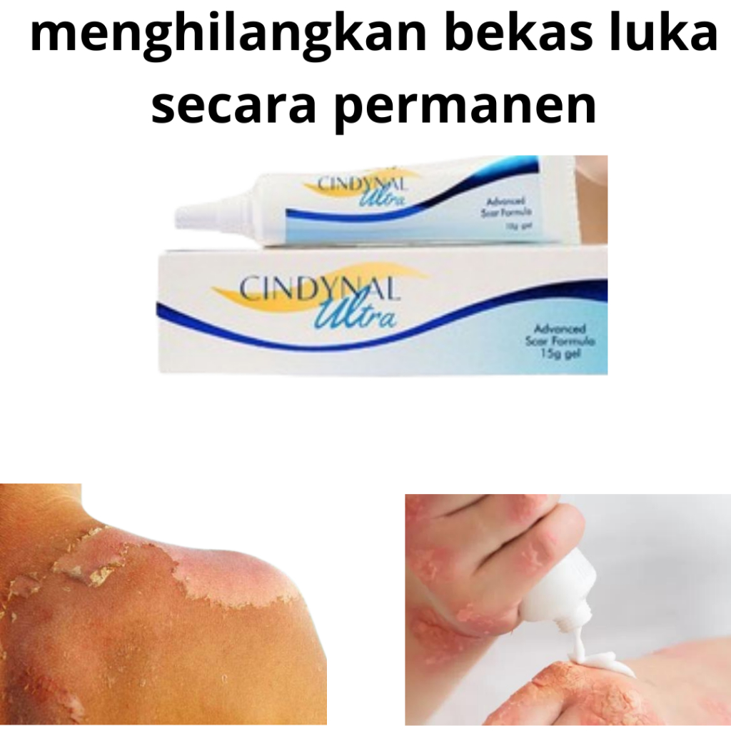 Krim Untuk Penghilang  Bekas Luka Sesar Bekas Luka Kenalpot,Luka Bakar Bekas Jerawat,Salep Jaitan Bi