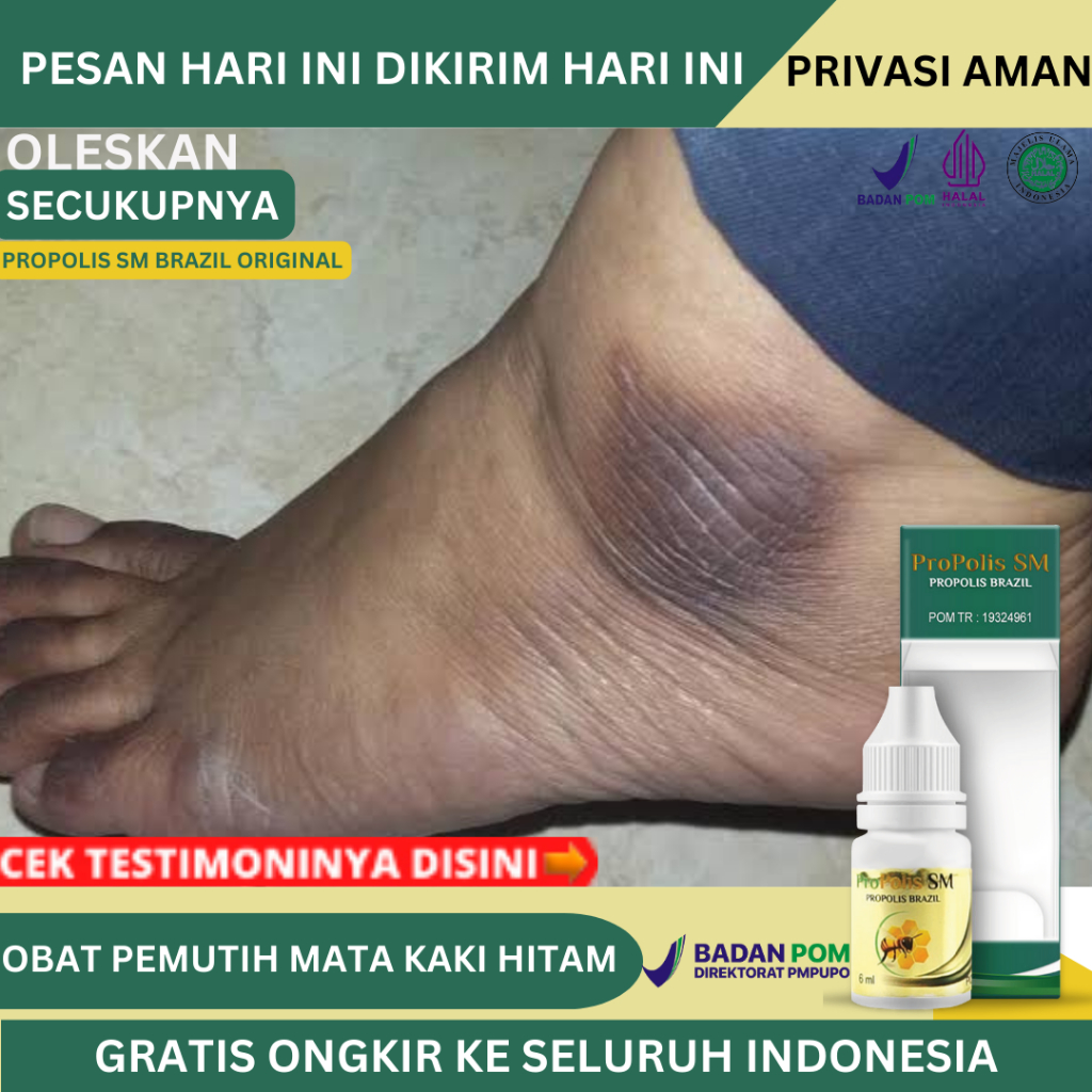 Obat Pemutih Mata Kaki Hitam, Obat Mata Kaki Hitam Dan Kasar, Obat Mata Kaki Hitam Kapalan, Obat Ole