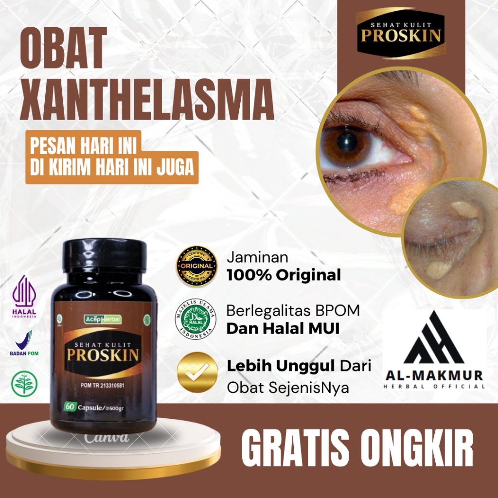 Obat Xanthelasma, Obat Untuk Menghilangkan Xanthelasma, Obat Gumpalan Lemak Di Kelopak Mata, Obat Pe