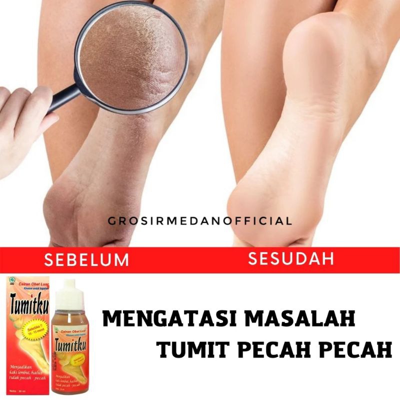 TUMITKU UNTUK KAKI KAPALAN JADI MULUS KEMBALI