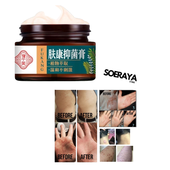 Salep gatal paling ampuh obat gatal salep gatel salep cina salap gatal salep obat gatal gatal Diimpo