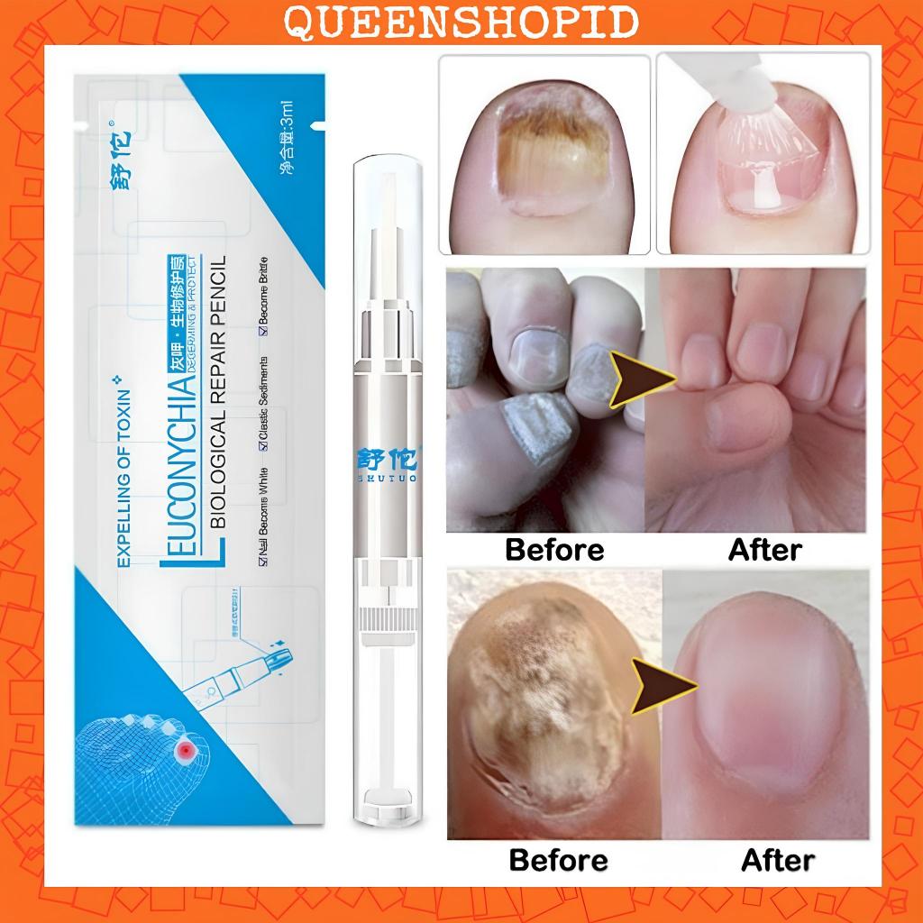 Obat Salep Kuku Herbal Membantu Hilangkan Jamur Pada Kuku Kaki Dan Tangan