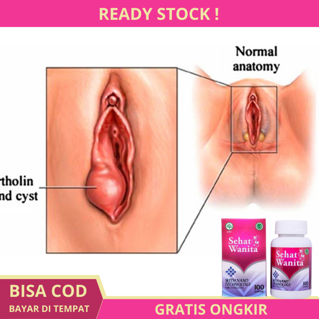 Obat Benjolan di Miss V - Obat Penghilang Benjolan di Miss V - Obat Benjolan Vagina - Obat Pengempis