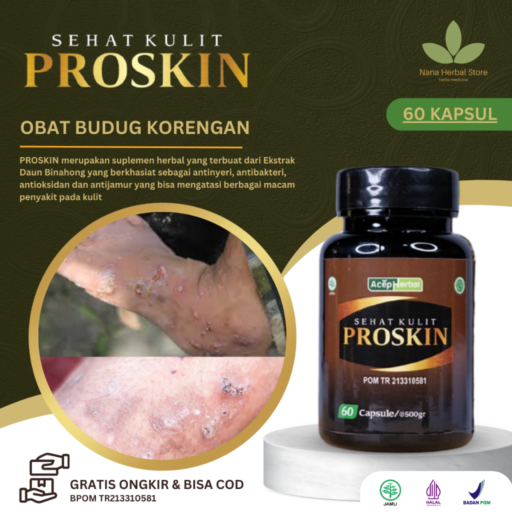 Obat Budug Kulit Gatal, Obat Budug Bernanah, Obat Budug Anak, Obat Koreng Akibat Jamur, Obat Koreng 