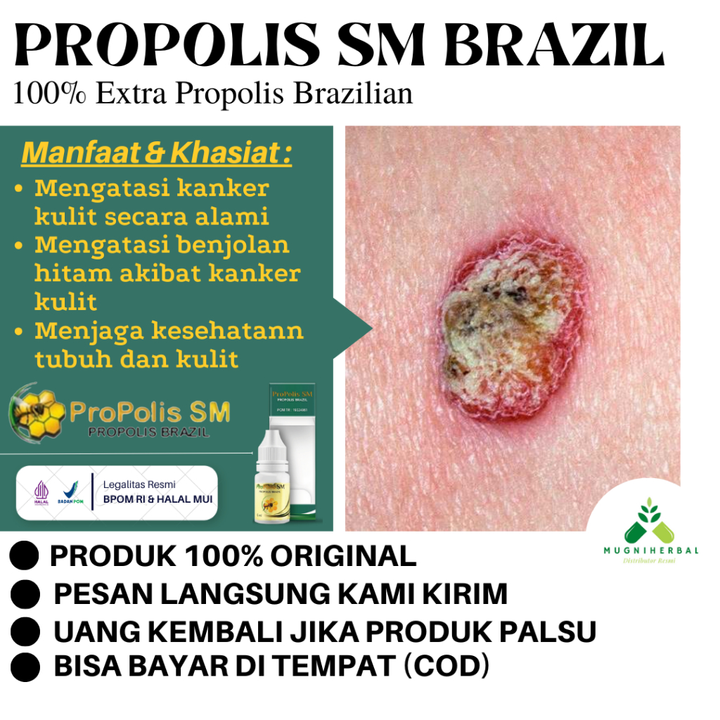 Propolis SM - Obat Kanker Kulit, Kanker Kulit Melanoma, Kanker Kulit Di Tangan/Kaki, Obat Oles Pengh