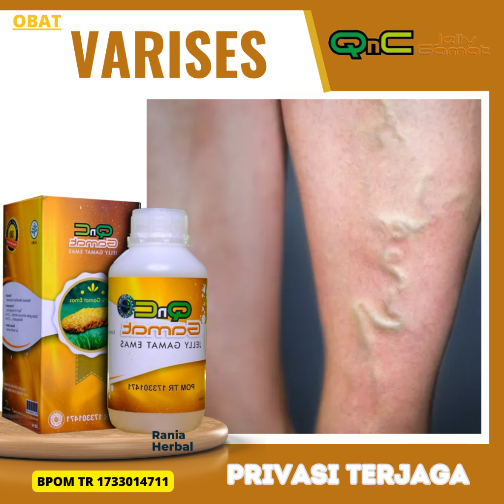 Obat Varises,  Obat Urat Menonjol, Obat Varises Tromboflebitis Bengkak, Obat Varises Pelancar Pembul