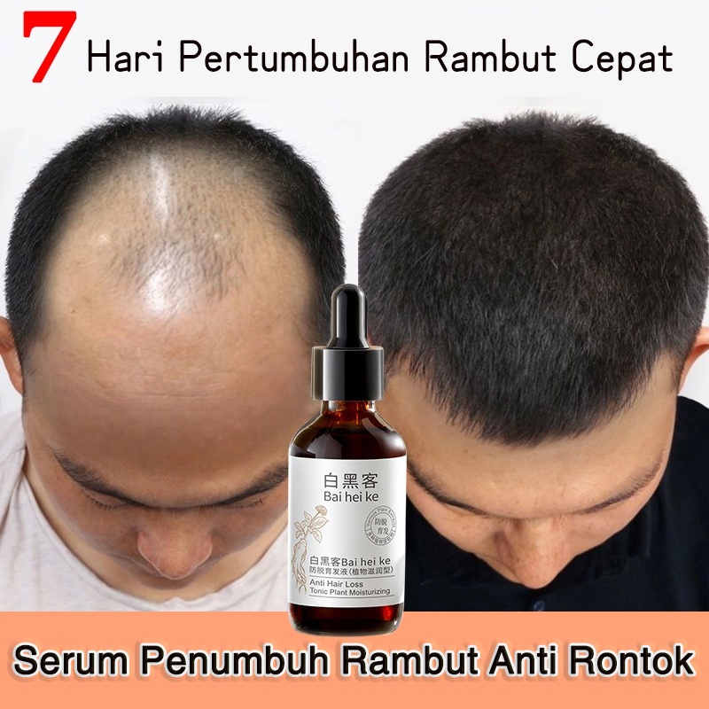 Serum rambut rontok hair growth serum obat penumbuh rambut 60ml Memperbaiki rambut rontok Cocok untu