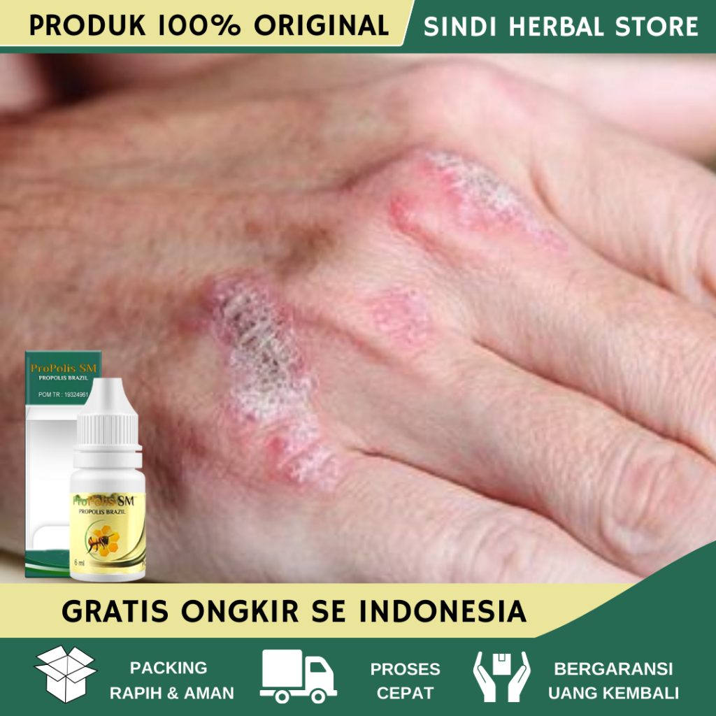 Obat Eksim Kering Menahun, Obat Eksim Kering Basah Psoriasis, Obat Gatal Kulit Eksim, Obat Penghilan