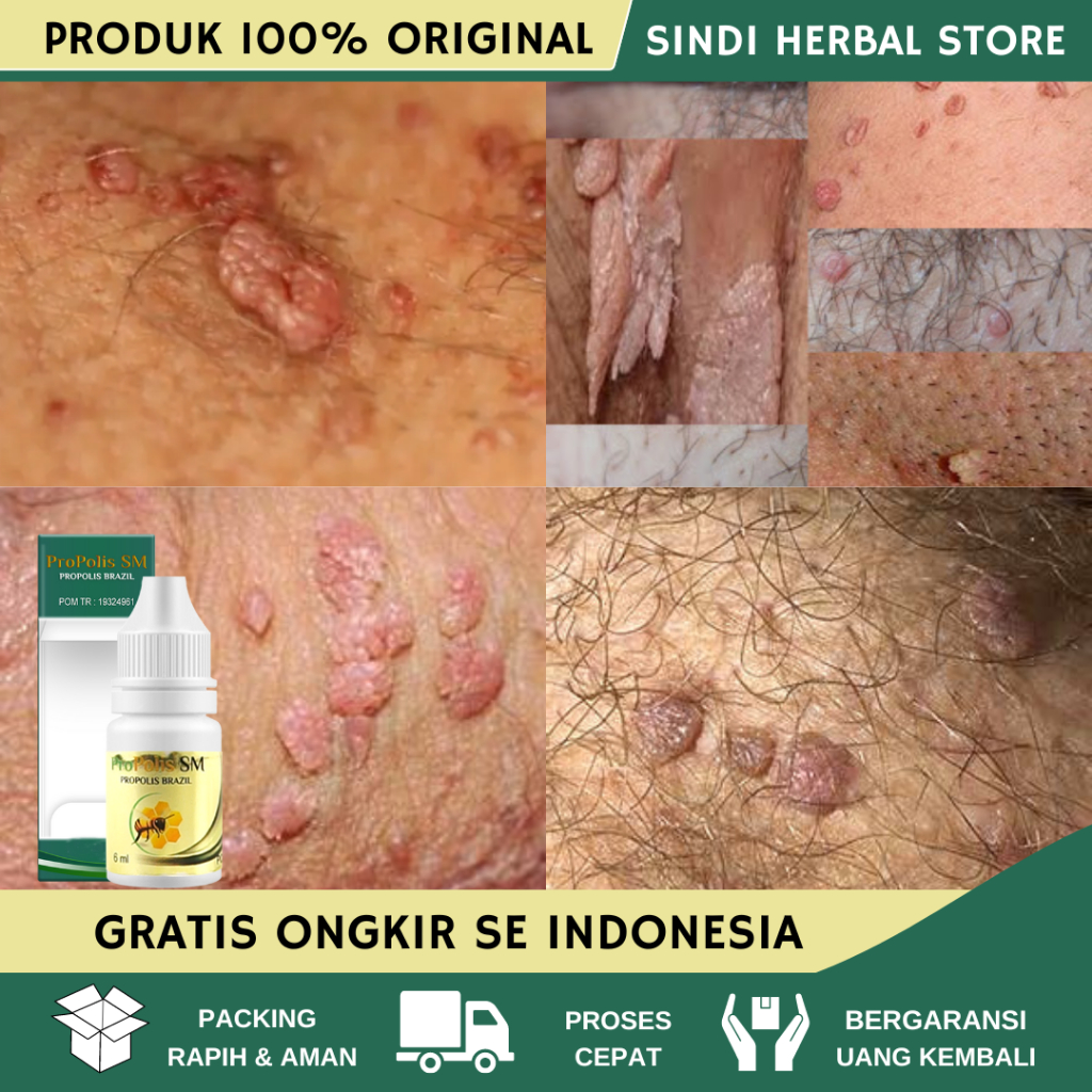 Obat Kutil Kelamin, Obat Kutil Kelamin Pria Wanita BPOM, Obat Kutil Kelamin HPV, Obat Kutil Kemaluan