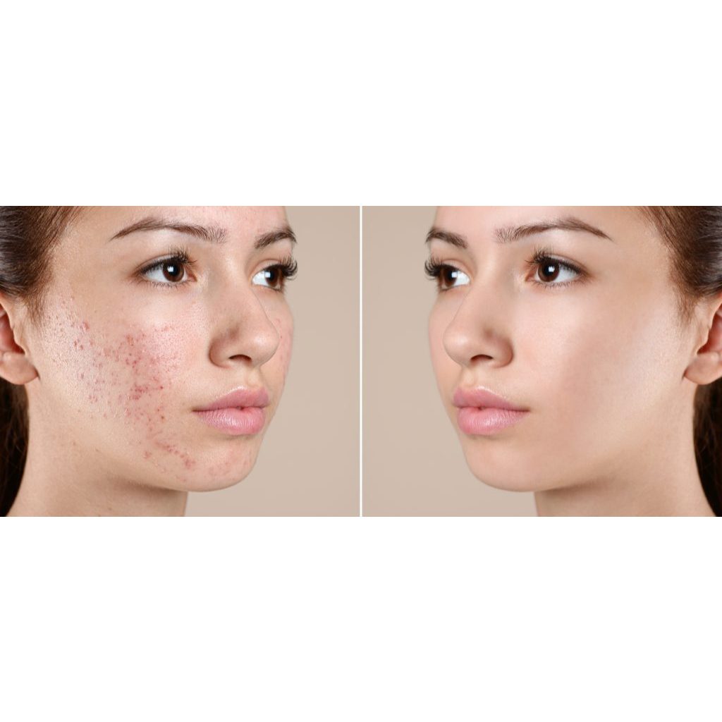 VOUCHER CHEMICAL PEELING ACNE