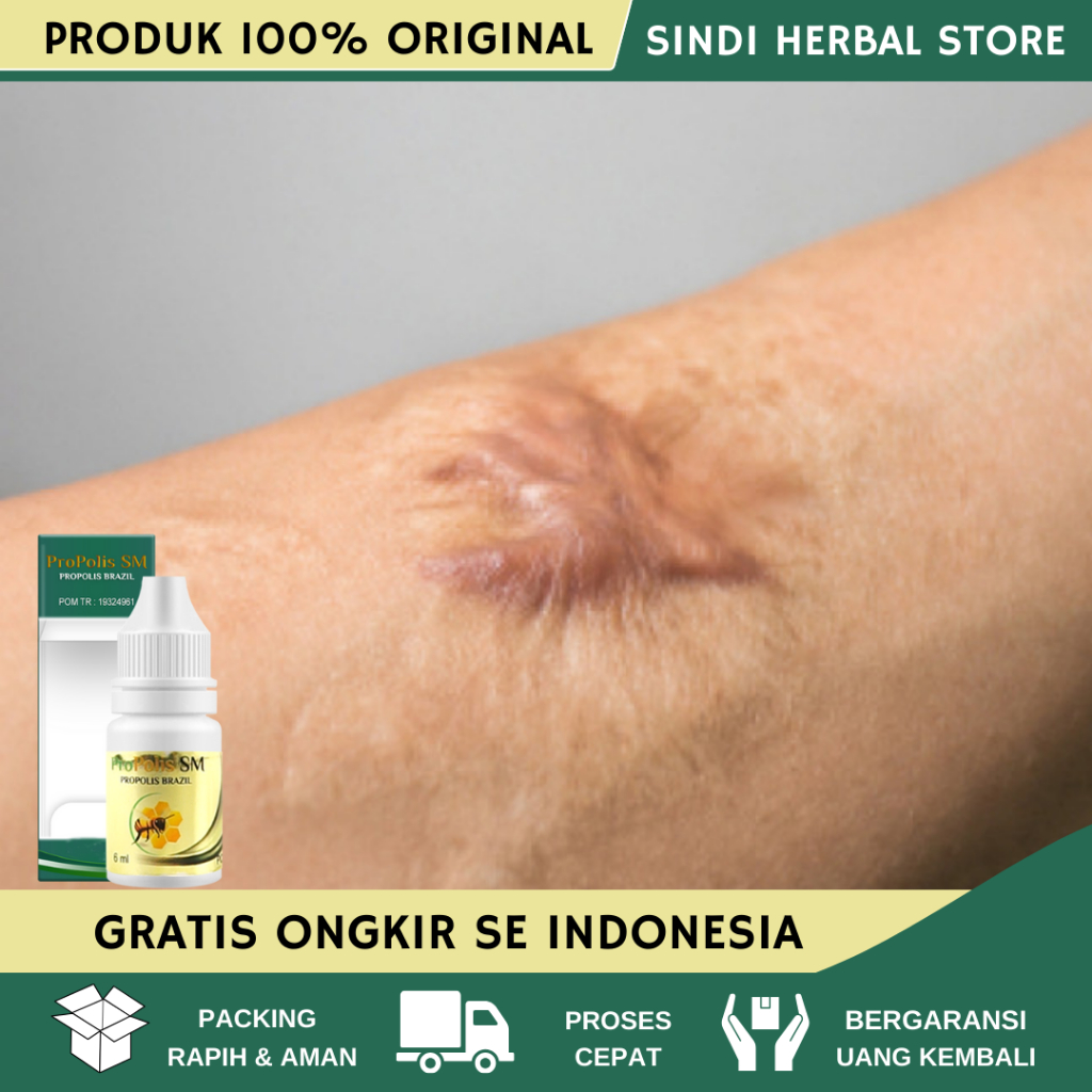 Obat Keloid, Obat Keloid Daging Tumbuh, Obat keloid Luka tindik, Obat Keloid Menahun, Obat Penghilan