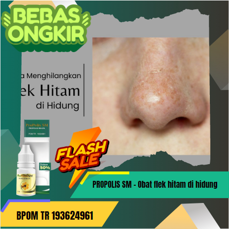 Obat flek hitam di hidung, menghilangkan flek hitam di wajah, agar flek hitam di wajah cepat mengelu