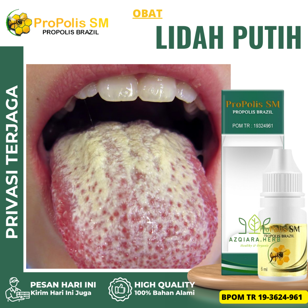 Obat Lidah Putih, Obat Lidah Berjamur, Obat Pembersih Lidah Putih, Obat Lidah Mati Rasa, Obat Lidah 