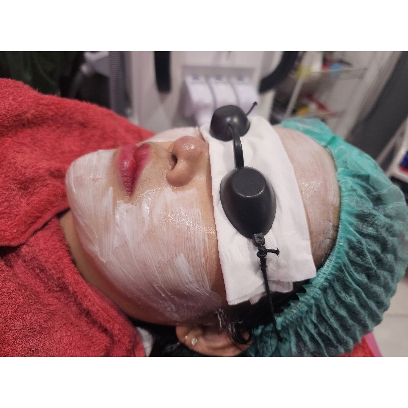 Treatment HIFU DOUBLE CHIN