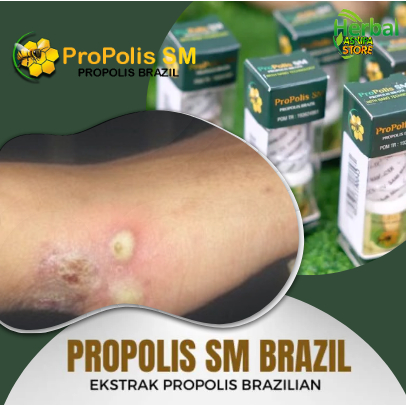 Obat Penghilang Korengan, Korengan Bernanah, Korengan Pada Kepala, Korengan Pada Kulit, Kaki Koreng 