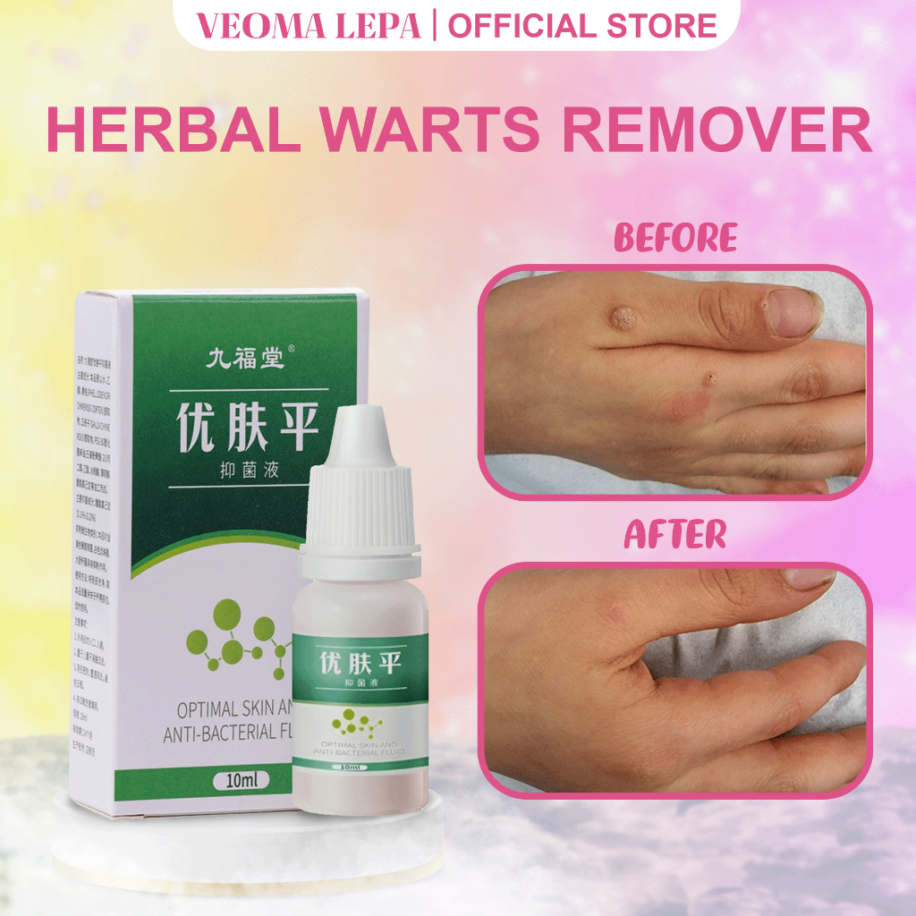 Penghilang Kutil Dan Tahi Lalat Obat Penghilang Kutil Di Wajah Papiloma Wajah Kutil Leher Penghilang