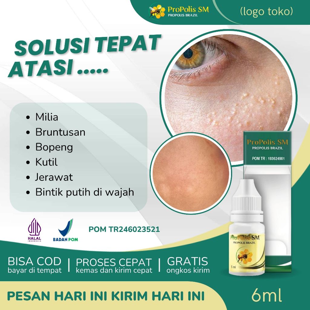 Obat Penghilang Milia, Obat Milia di Kelopak Mata, Obat Milia Pada Wajah, Obat Milia di Hidung, Obat