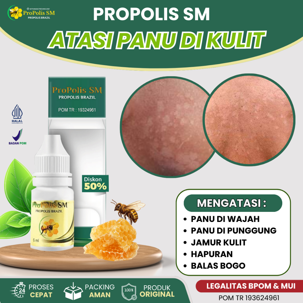 Obat Panu Di Kulit, Obat Balas Bogo, Obat Bercak Putih Di Wajah, Obat Hapuran, Obat Infeksi Jamur Di