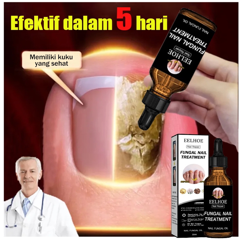 NEW Obat Jamur Kuku Perawatan Kuku Obat Kuku Jamur dan Rusak Penghilang Jamur Kuku Obat Infeksi Kuku