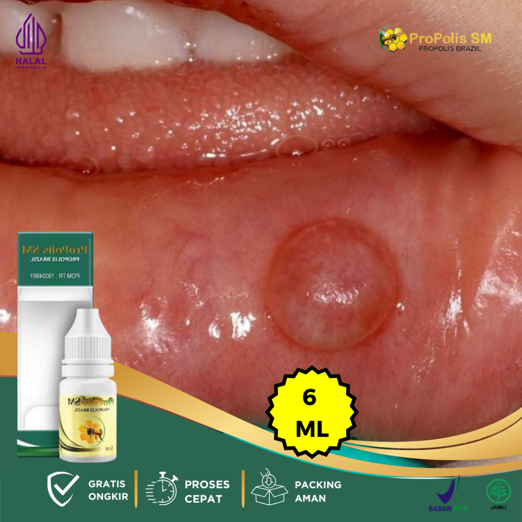 Obat Kista Mukokel, Obat Penghilang Benjolan Di Bawah Lidah, Obat Benjolan Mulut, Obat Benjolan Di B