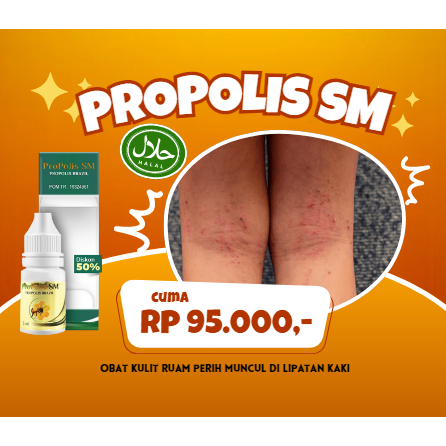 Obat Gatal - Gatel Menghilangkan Kulit Ruam Perih Muncul Di Lipatan Kaki, Tangan, Pantat & Selangkan