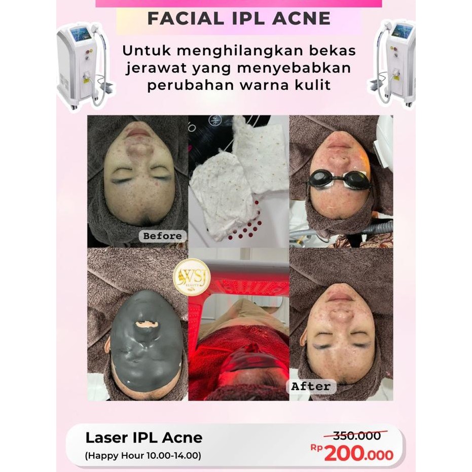 TREATMENT FACIAL IPL ACNE PROMO